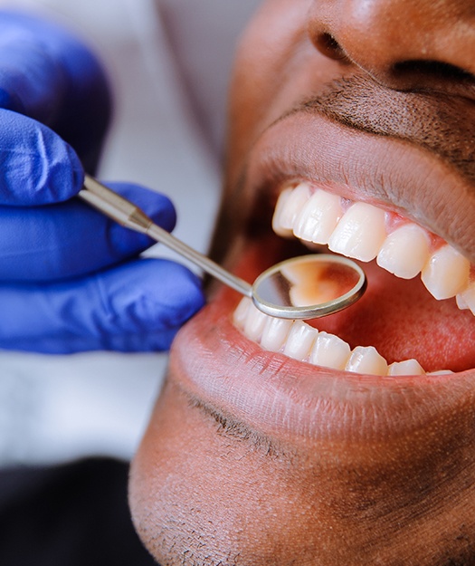Dentist checking man's smile after tooth colored filling treatment